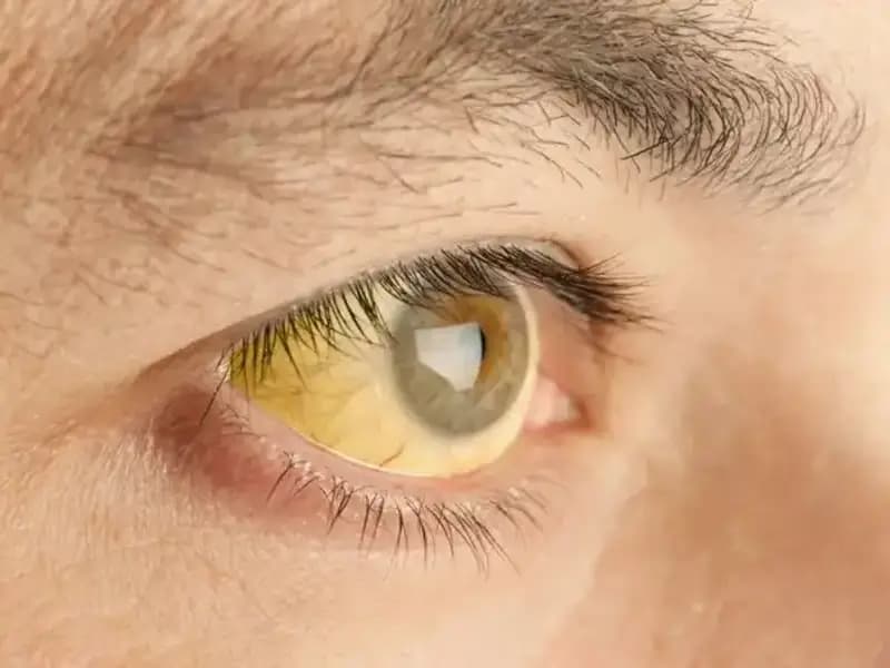 Karaciğer Sağlığınızı Gösteren İşaretler: Gözlerinizi Kontrol Edin!